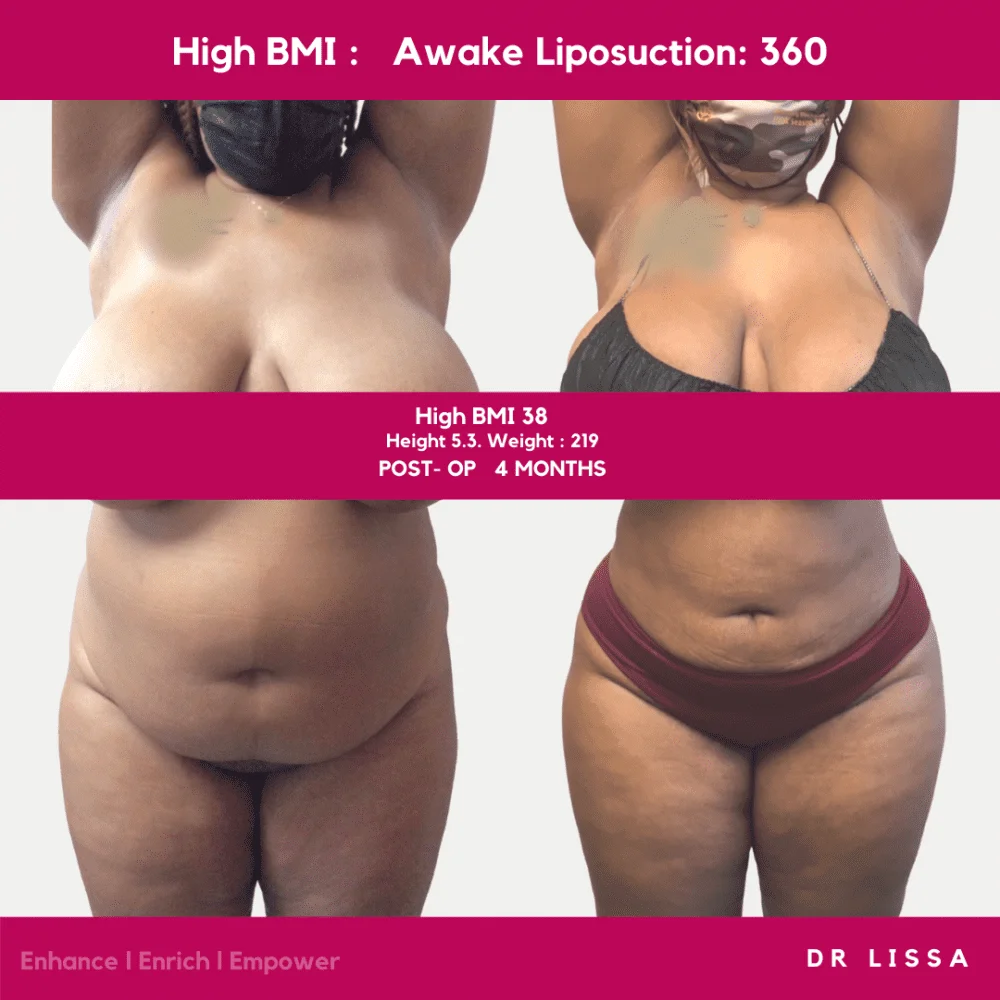 Before and after Awake Lipo results