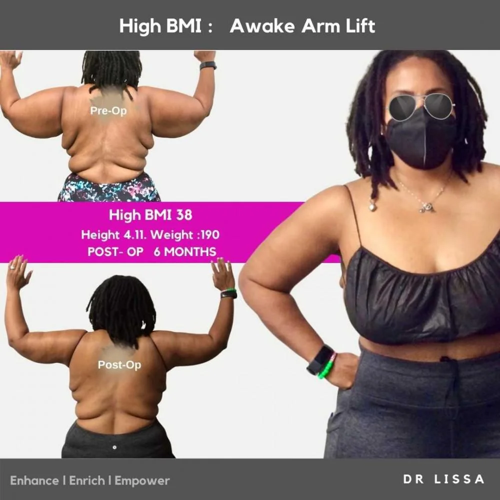 Before and after results with Dr. Lissa Awake Arm Lift