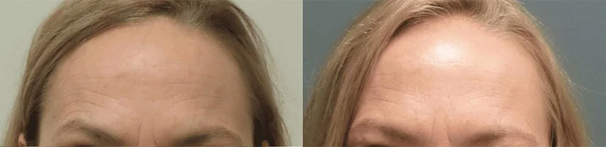Real patient BOTOX before and after photos