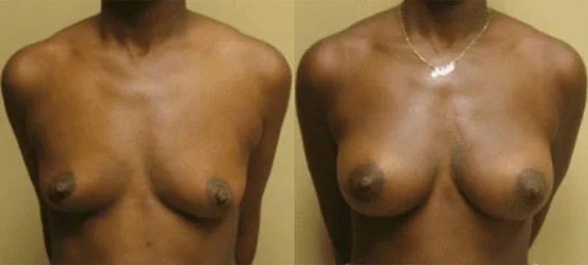 Breast Augmentation real patient before and after photos
