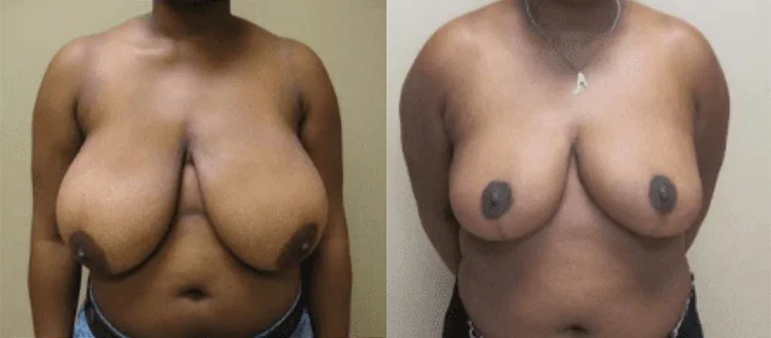 Real patient Breast Reduction before and after photo
