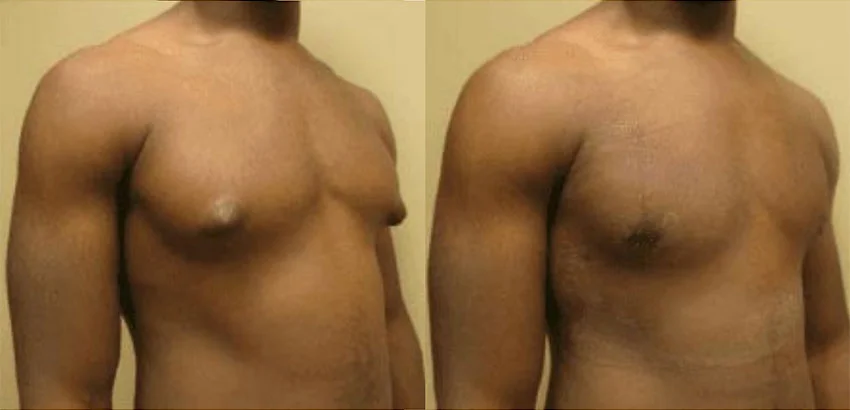 Real patient Gynecomastia before and after photos