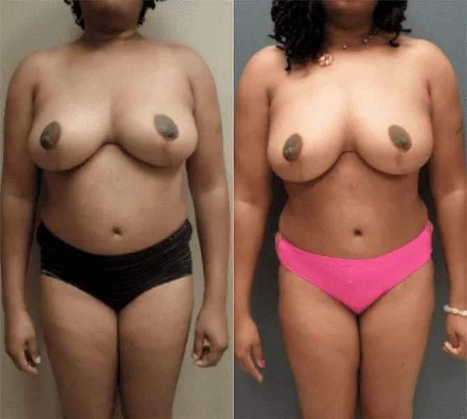 Real patient photos - Liposuction before and after