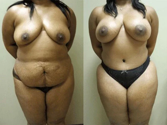Real patient photo - Tummy Tuck before and after results