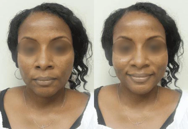 Photo of actual Dermal Filler patient