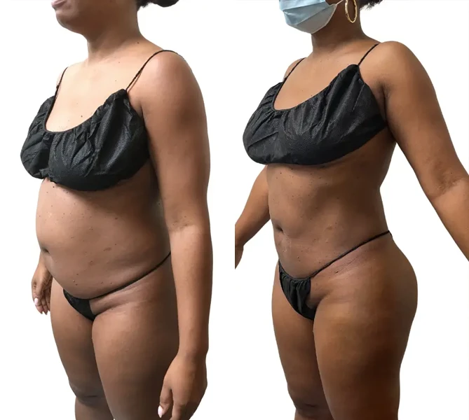 liposuction-before-after3